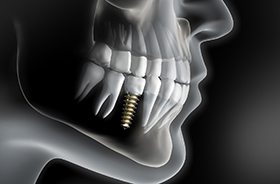 Illustration of dental implant in patient’s lower jaw