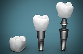 Animation of the implant tooth replacement process