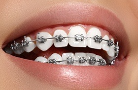 Closeup of teeth with metal braces