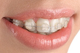 Closeup of teeth with ceramic braces