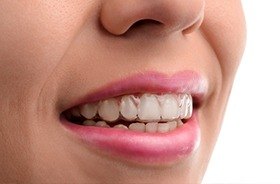 Closeup of smile with Invisalign