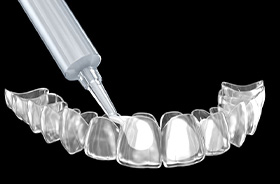 Teeth whitening formula being placed in custom tray