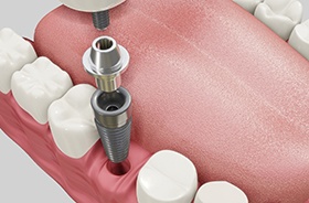 Illustration of dental implant and abutment for lower dental arch