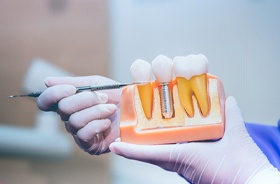 Gloved hands holding dental model, explaining types of dental implants