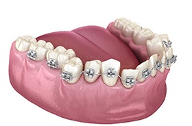 Illustration of metal braces on crooked lower arch