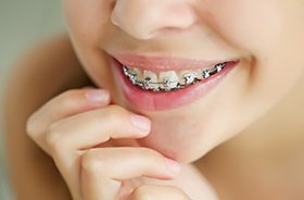 Close-up of woman’s smile with braces in New Haven