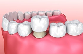 Animation of dental crown placement