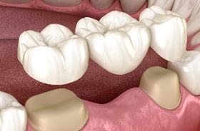 Illustration of three-unit dental bridge being placed on teeth