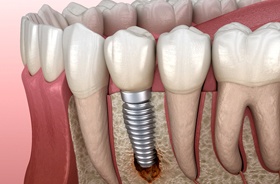 Illustration of peri-implantitis, a common cause of dental implant failure