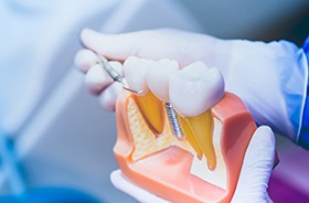 Dentist holding implant model, explaining how dental implants work