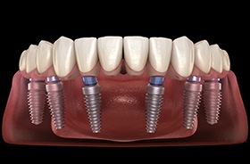Two dental implants in front of denture model