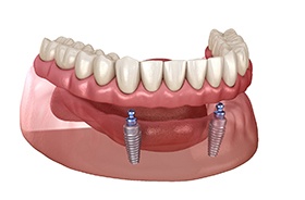 Illustration of implant dentures viewed from the front
