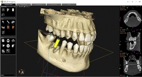 Patient’s jaw on computer screen, part of planning for implant surgery