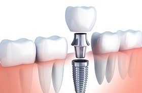 Animation of implant supported dental crown