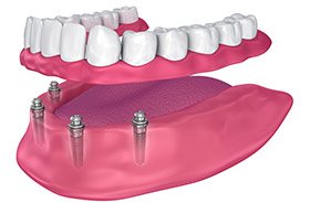 Animation of implant supported denture