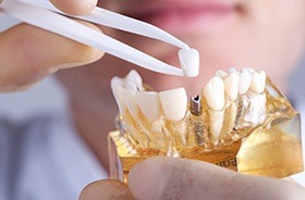 Model smile with implant supported dental crown