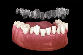 Illustration of Invisalign aligner being placed on crooked teeth