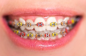 smile with braces