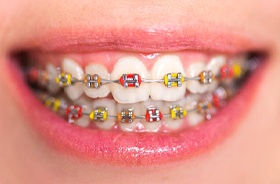 Cool Colors for Cool Smiles: Putting the Fun in Braces Treatment