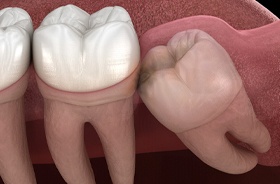 impacted wisdom tooth