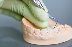 Model smile with fixed bridge restoration