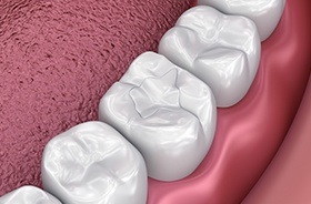 Animation of tooth with filling