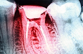 X-ray of root canal treated tooth