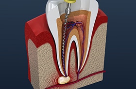 Illustration of tool being used during root canal therapy