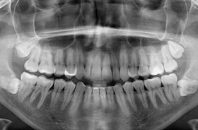 x-ray showing four impacted wisdom teeth