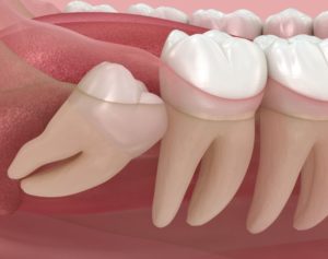 Illustration showing impacted wisdom tooth