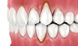 Digital image of gum recession
